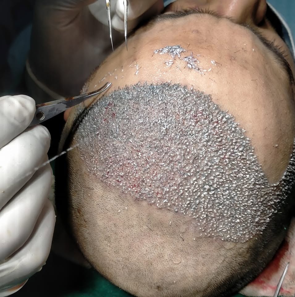 GRAFT Hair Transplant Centre Patna — clinical interior with professional equipment
