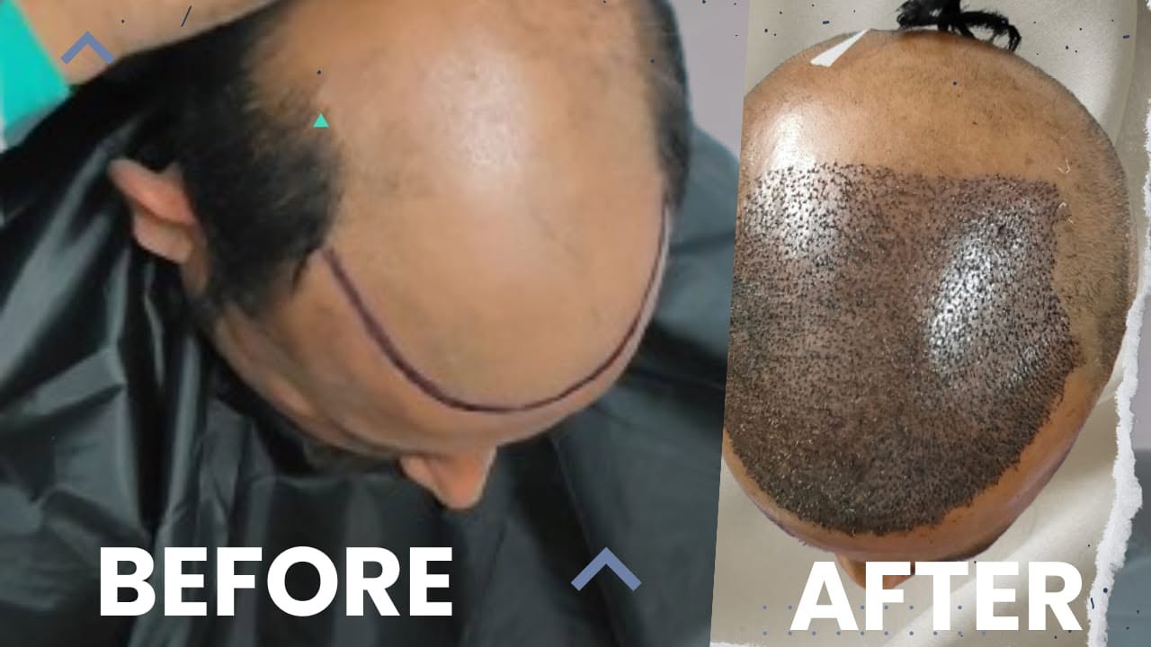 GRAFT Clinic team performing advanced hair restoration procedure